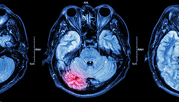 Brain Injuries